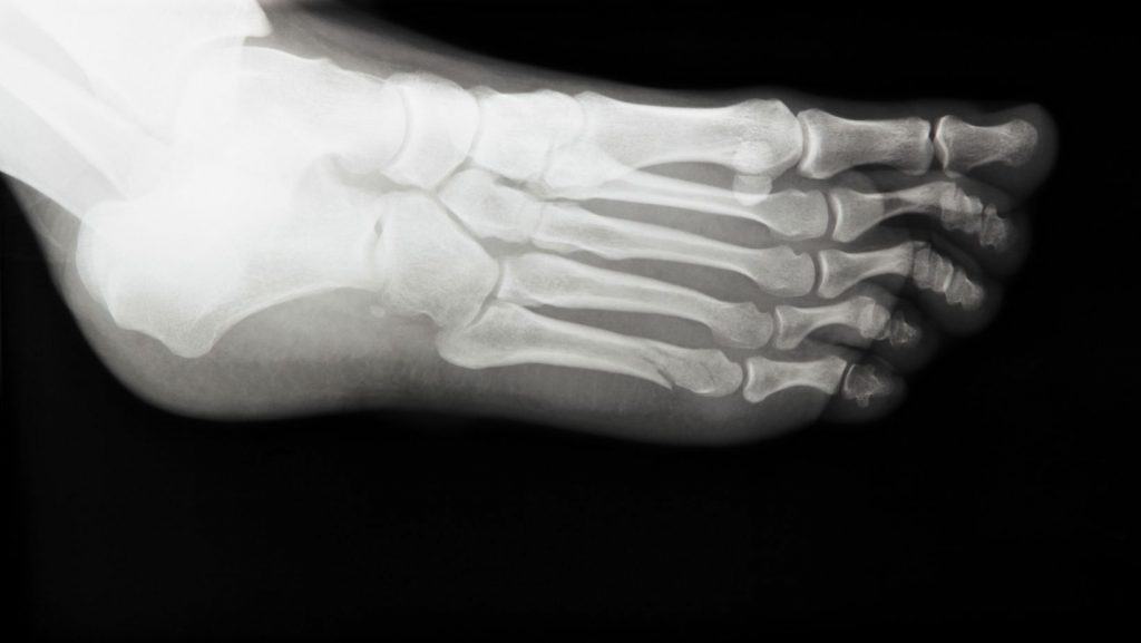 X-ray of 5th Metatarsal Fracture