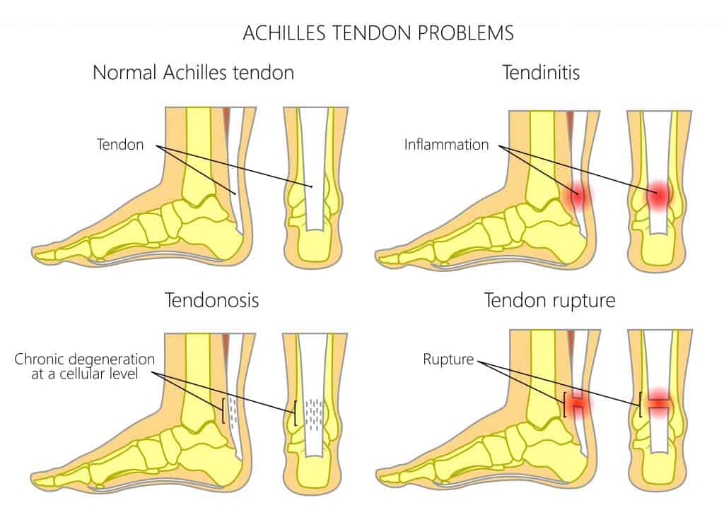 Achilles Tendon Problems diagram