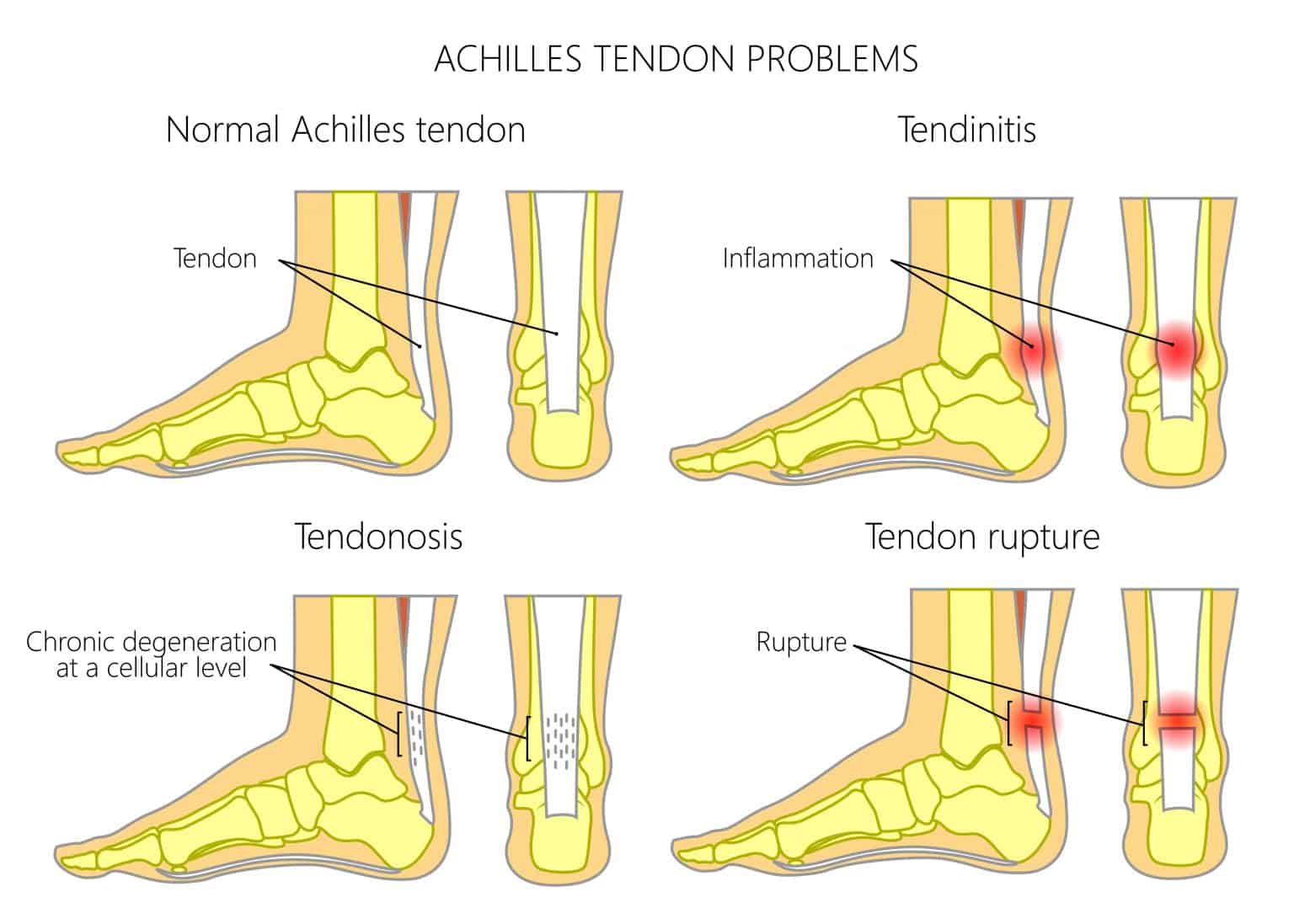 Mid-Portion Achilles Tendinopathy: Learn how to treat it