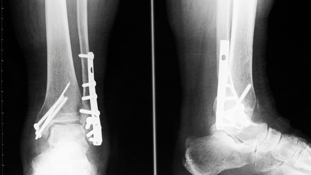 lateral malleolus fracture