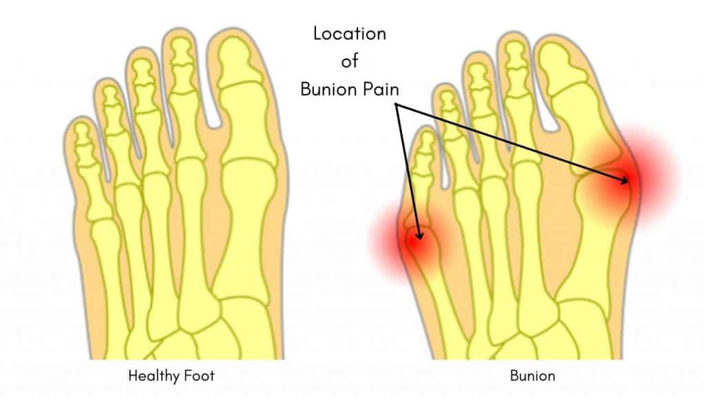 Bunions Diagram