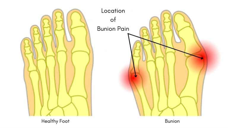 Bunion Pain What Causes Bunions Diagnosis And Home Treatment
