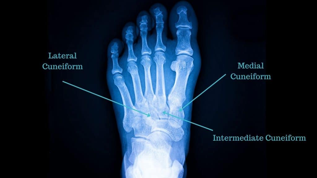 diagram of X-ray of a foot identifying the cuneifroms bones
