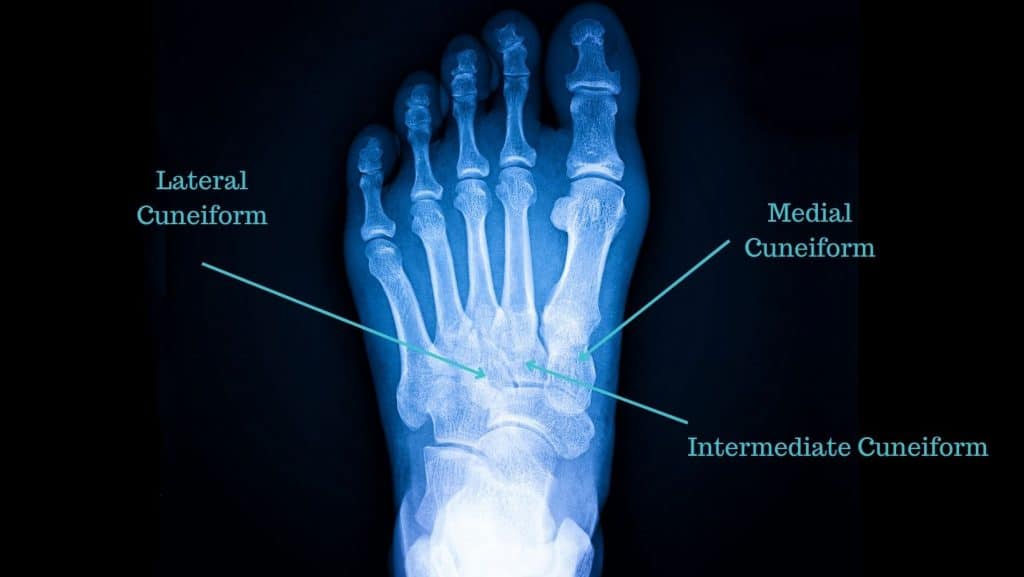 cuneiform bone fracture