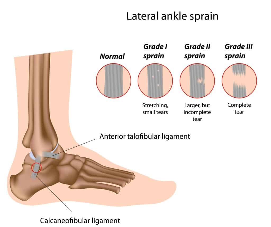 Diagram of lateral ligament ankle sprain