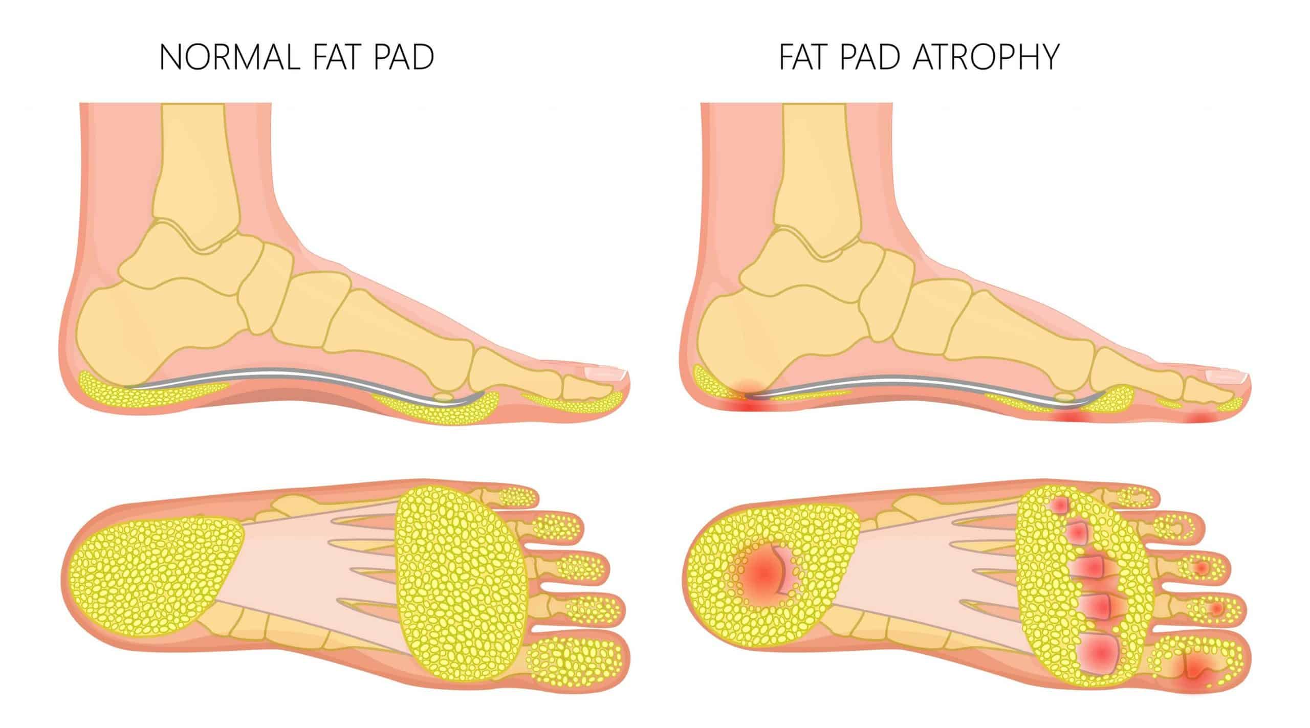 Fat pad clearance contusion heel treatment