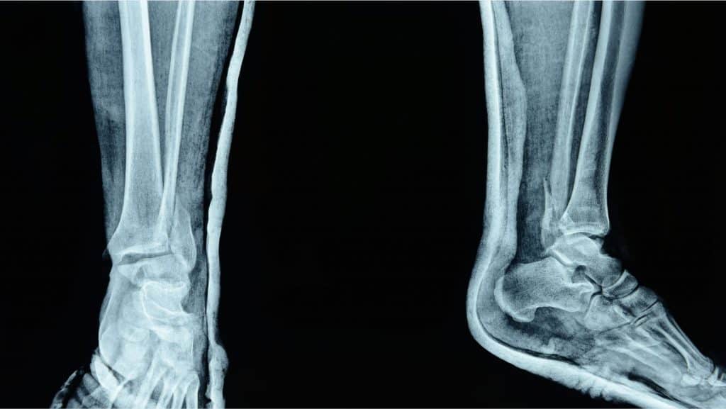 Scan of fibula fracture