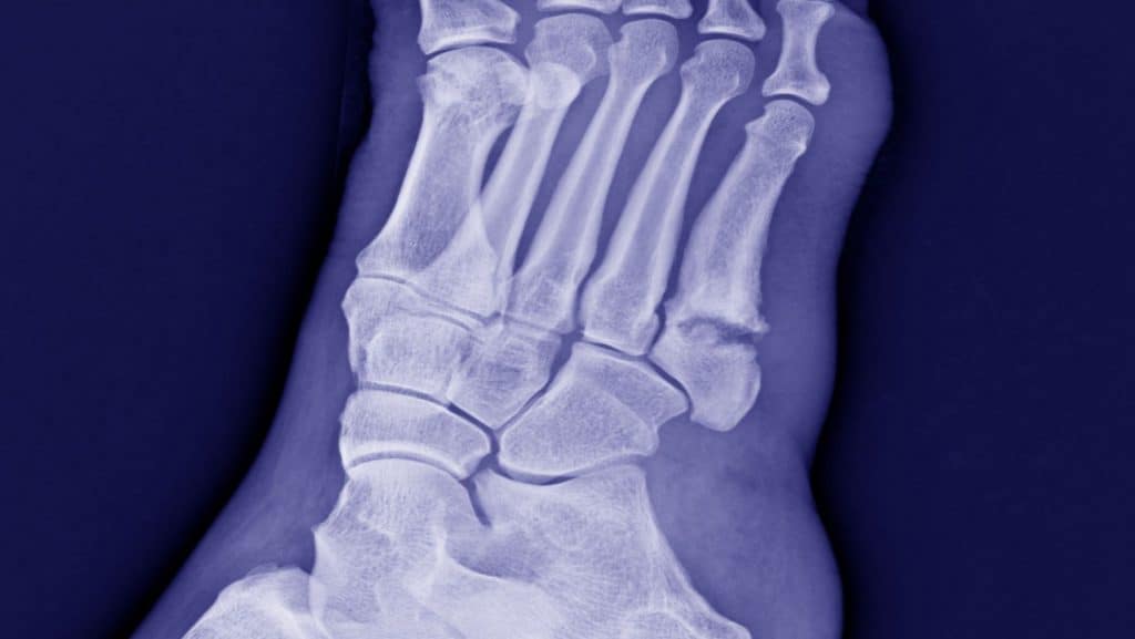 X-ray of Fifth Metatarsal Fracture