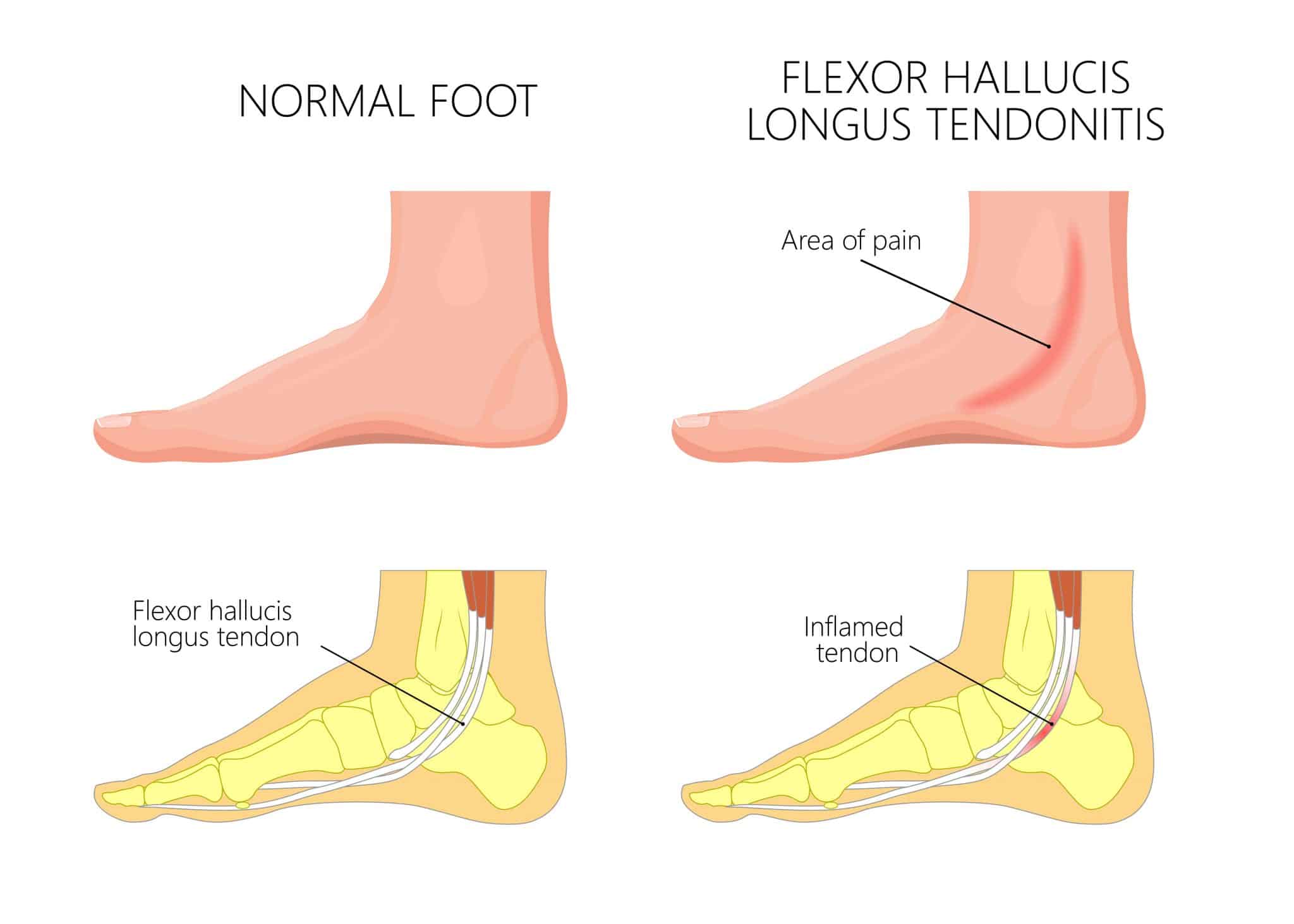 Flexor Hallucis Longus | Flexor Hallucis Longus Tendonitis