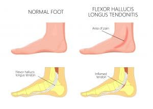 Flexor Hallucis Longus | Flexor Hallucis Longus Tendonitis