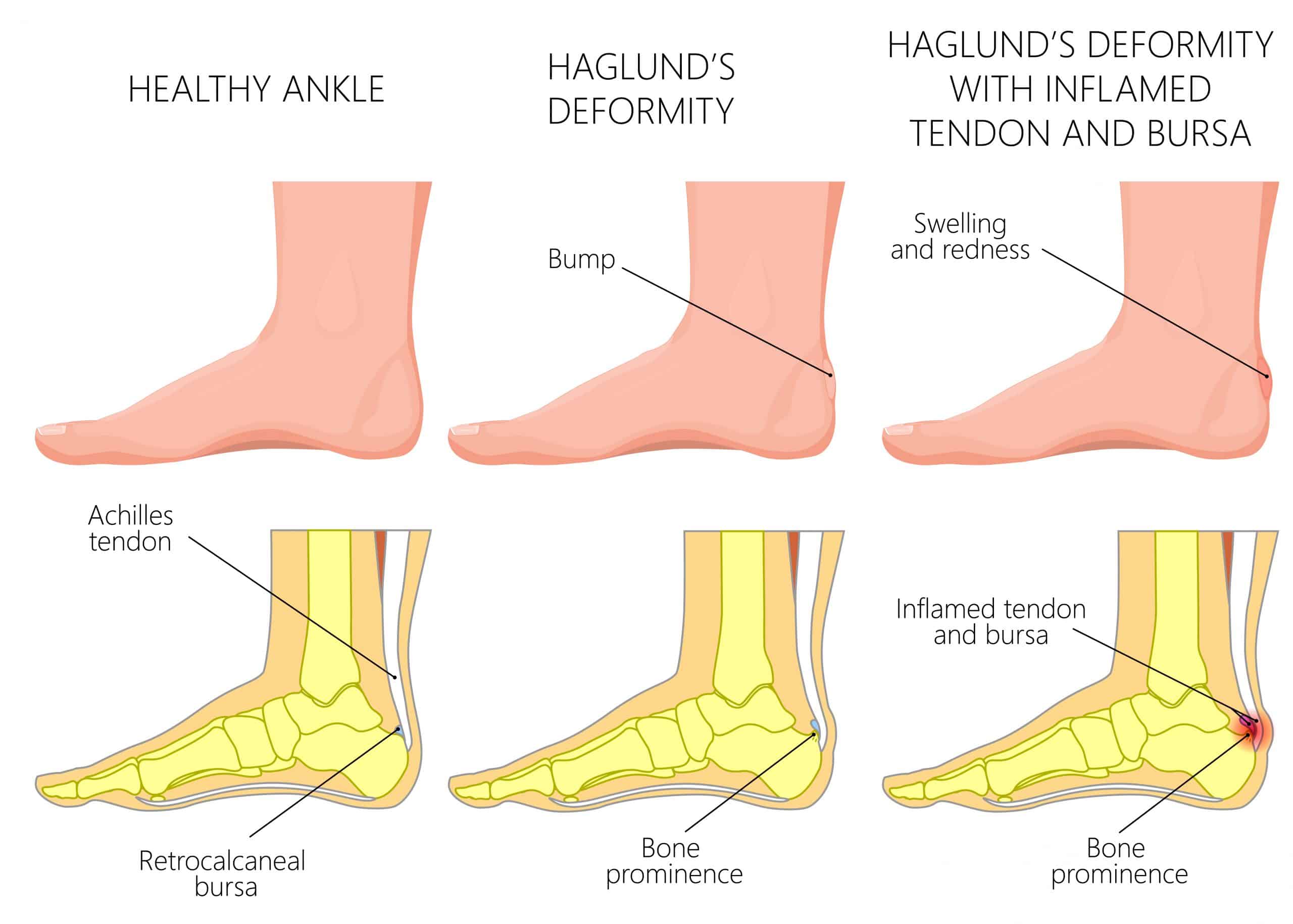 Picture diagram of baglunds deformity, bursitis and insertional achilles tendonitis