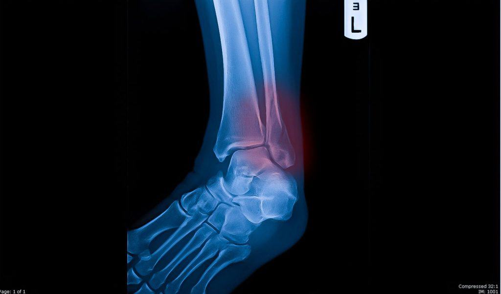 x-ray of Lateral Malleolus Fracture