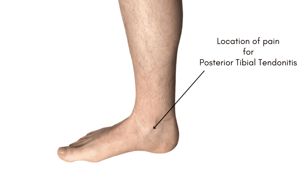 Picture of Location of Pain for Posterior Tibial Tendonitis