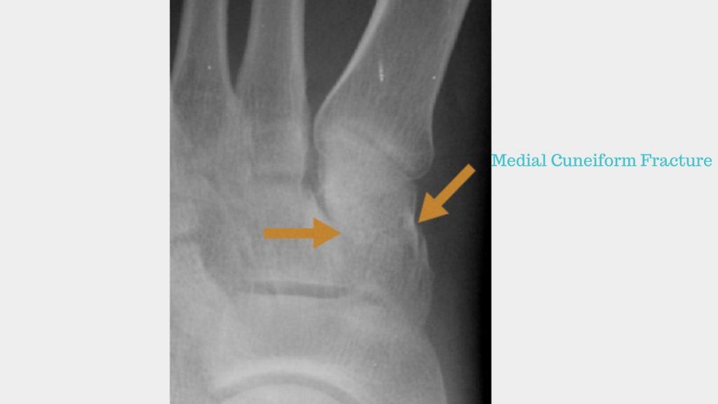 Medial Cuneiform Fracture on x-ray