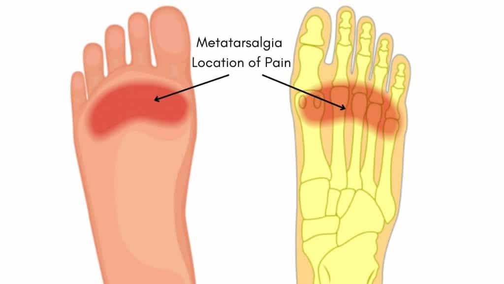 Metatarsalgia Diagram