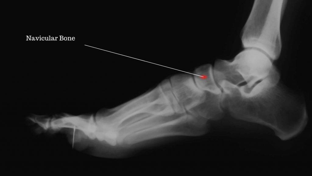 Picture of navicular bone on an x-ray