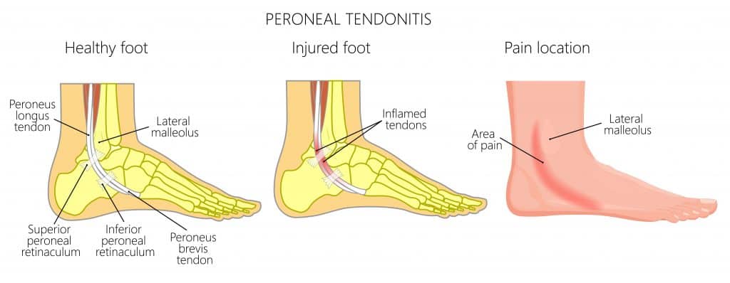 Peroneal Tendonitis Diagram