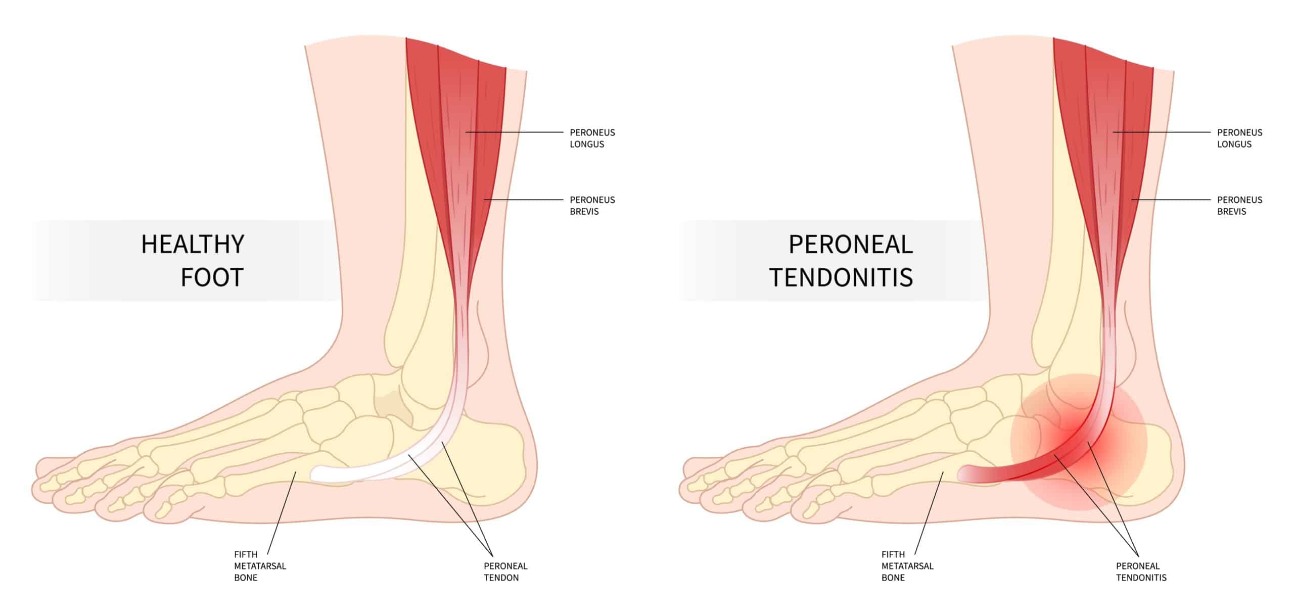 Peroneal Tendonitis: Symptoms, Causes and Treatment