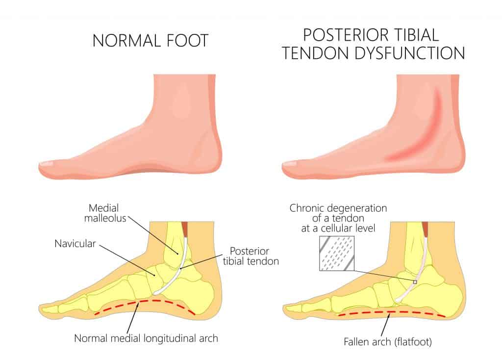 Picture Diagram of Posterior Tibial Tendon Dysfunction