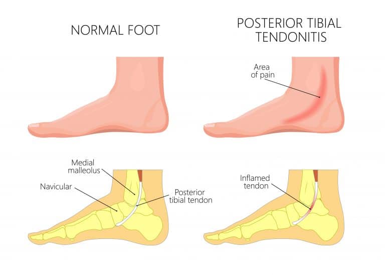 Posterior Tibial Tendonitis | Diagnosis, Symptoms and Treatments