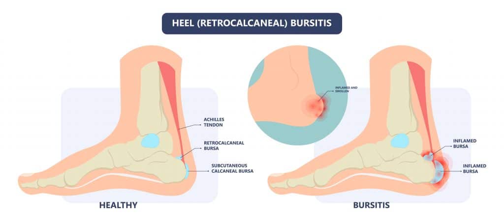 Diagram of Retrocalcaneal Bursitis