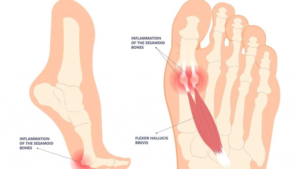 Sesamoiditis Diagram