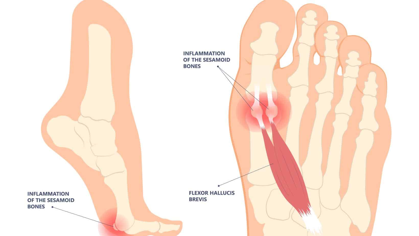 sesamoiditis taping