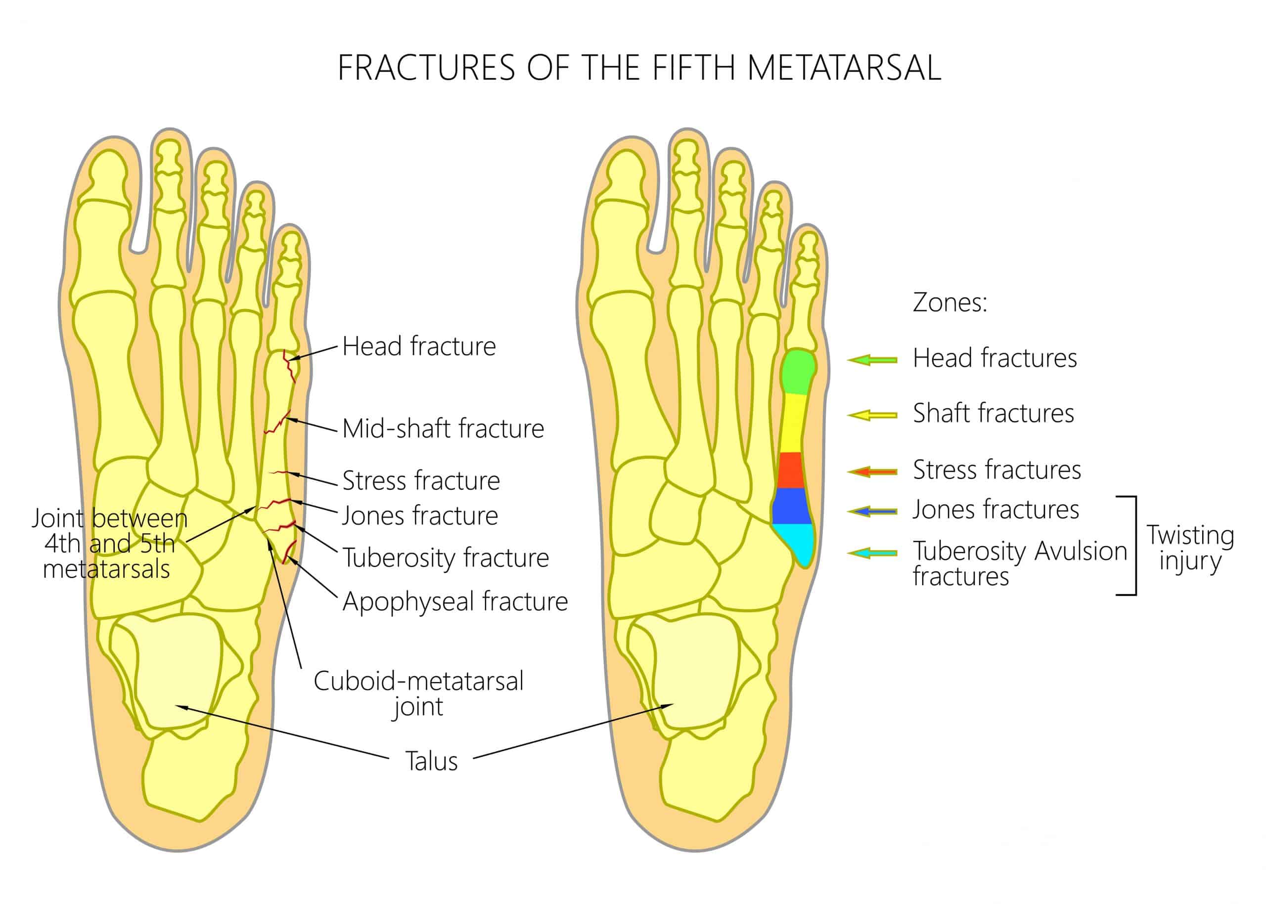 Diagram of Types of 5th metatarsal Fracture