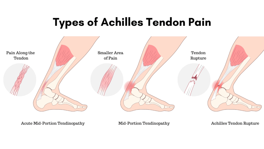Diagram of Types of Achilles Tendon Pain