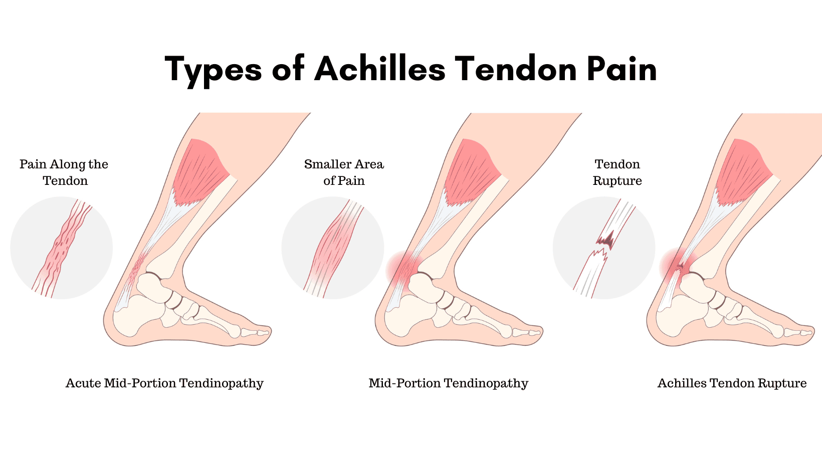 Achilles Tendinopathy Anatomy, Function, Diagnosis & Treatment