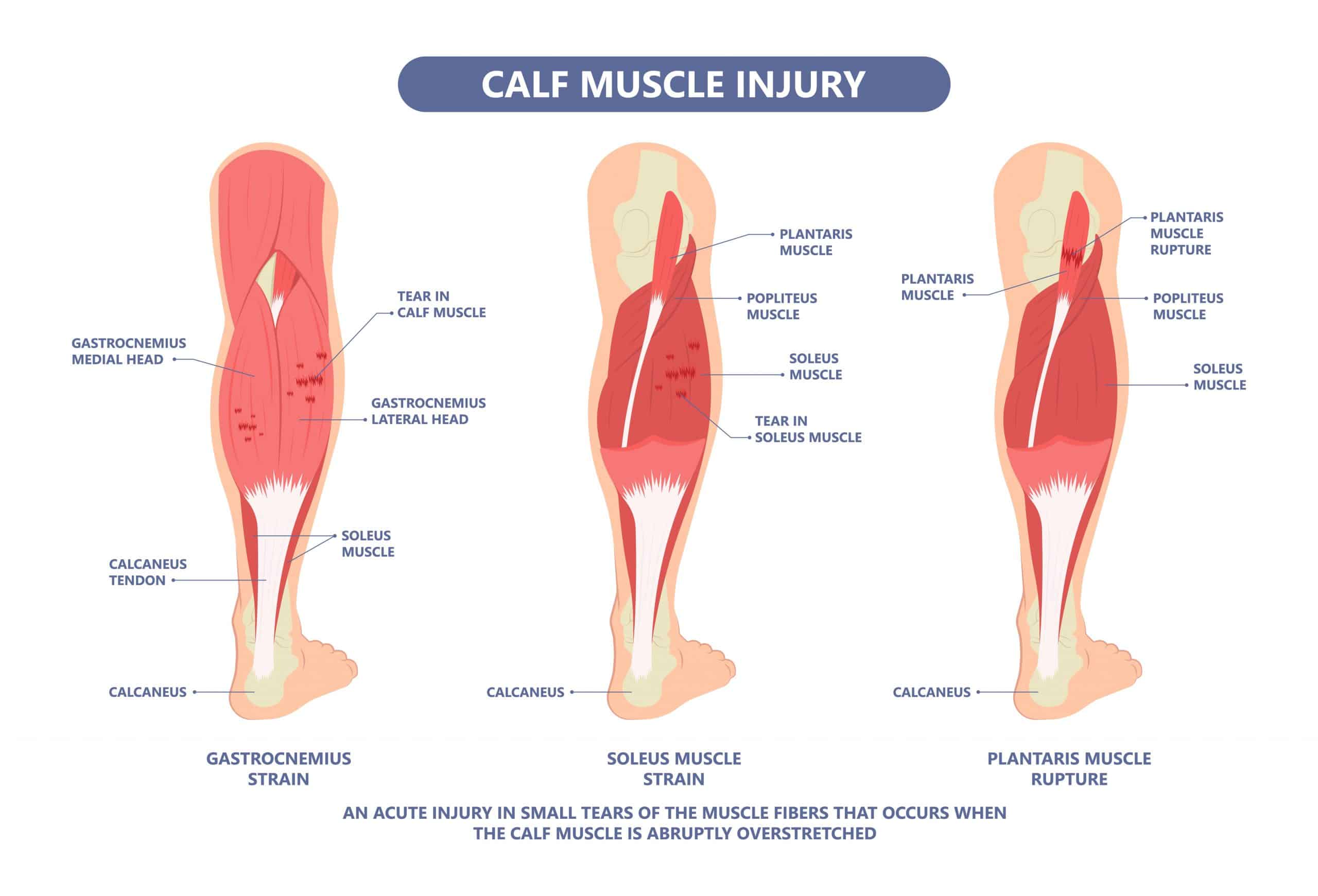 Torn Calf Muscles for Runner  Melbourne Sports Physiotherapy