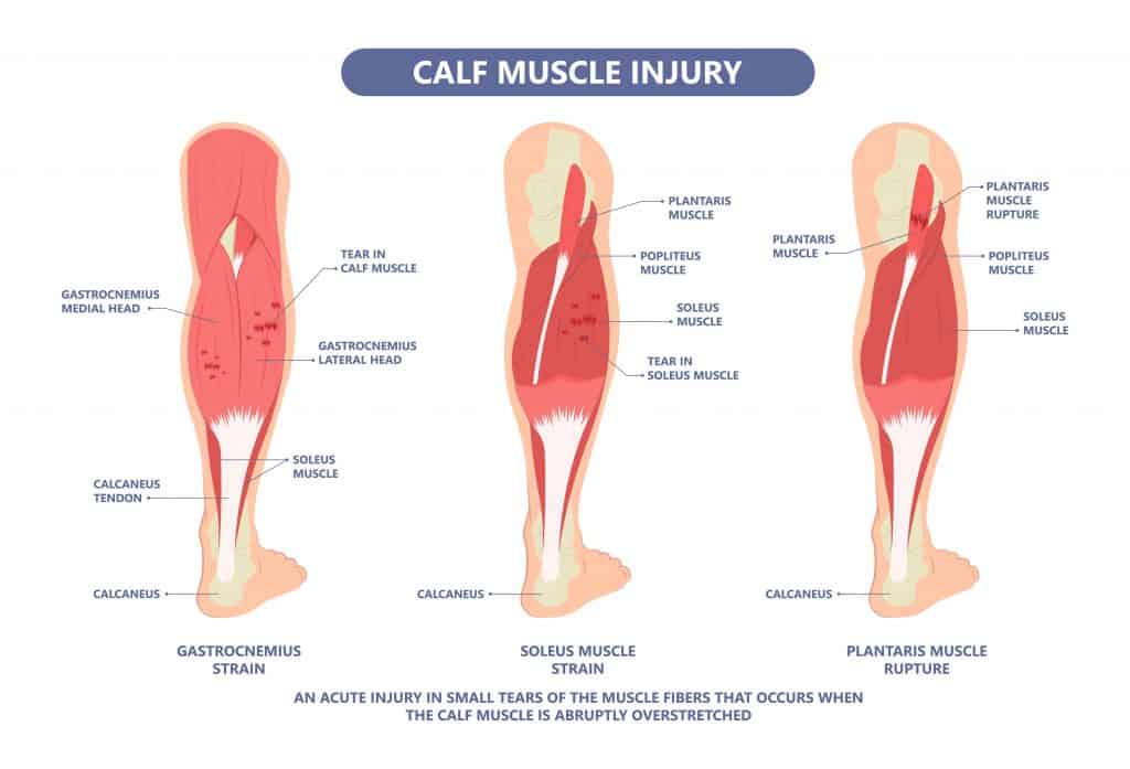 Diagram of Calf and Soleus Muscle Tears