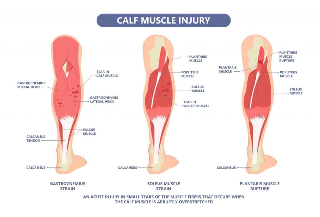 how-to-prevent-calf-cramps-while-running