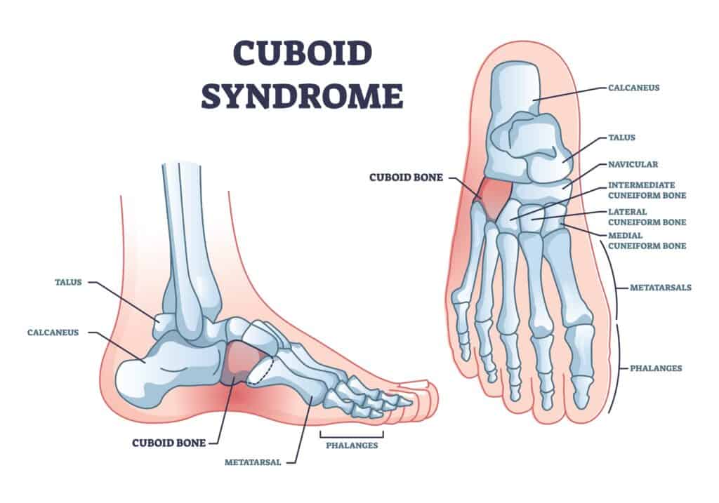 Cuboid Syndrome Diagram