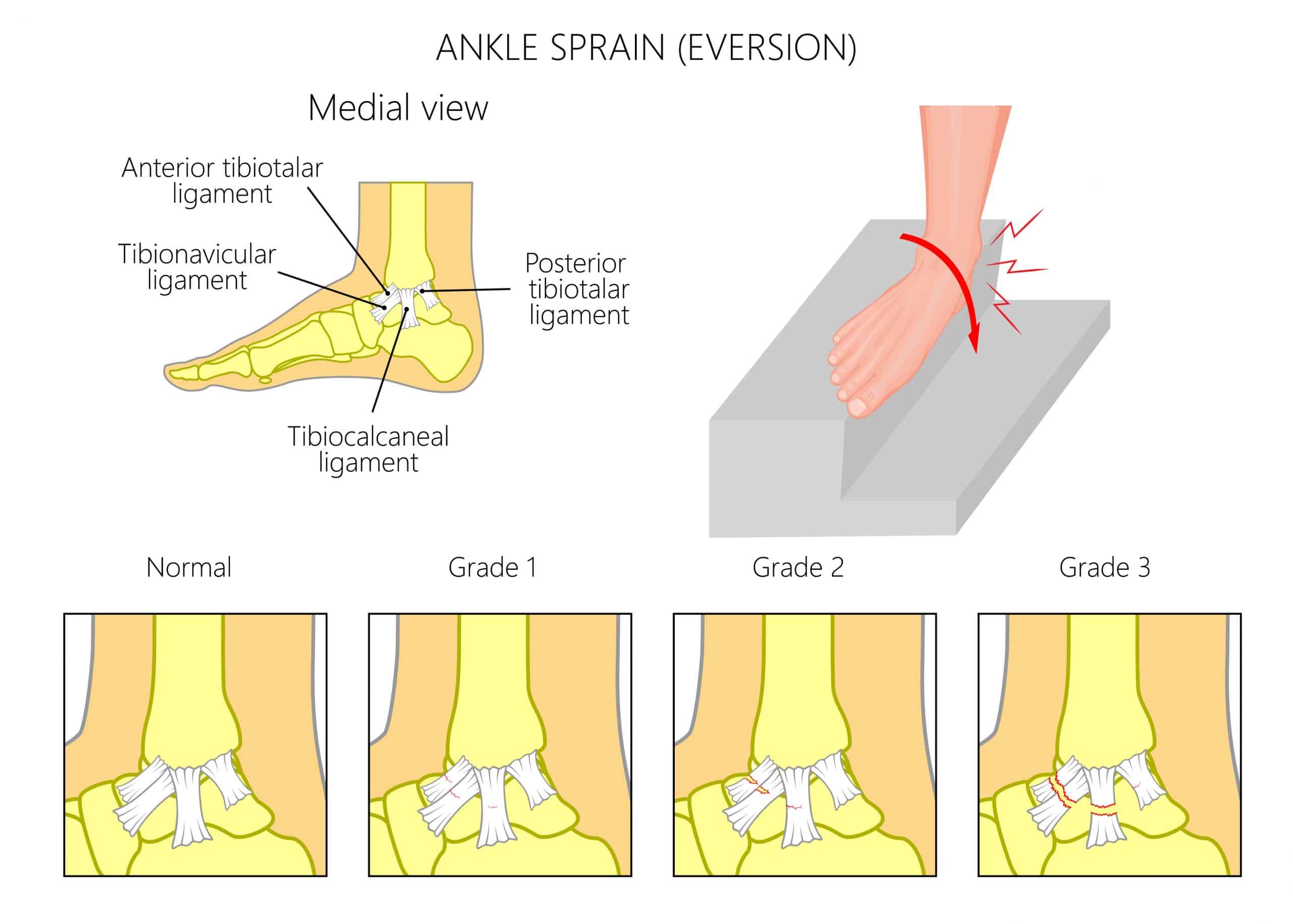 Ankle deltoid ligament tear doctorvisit