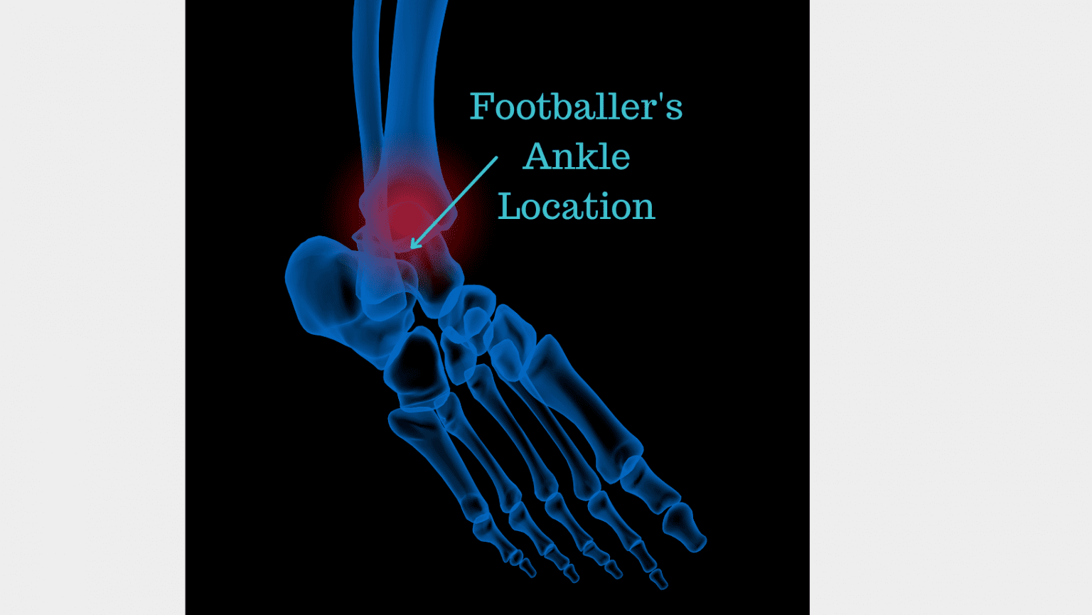 Footballer's Ankle Diagnosis, Causes, Symptoms and Treatment