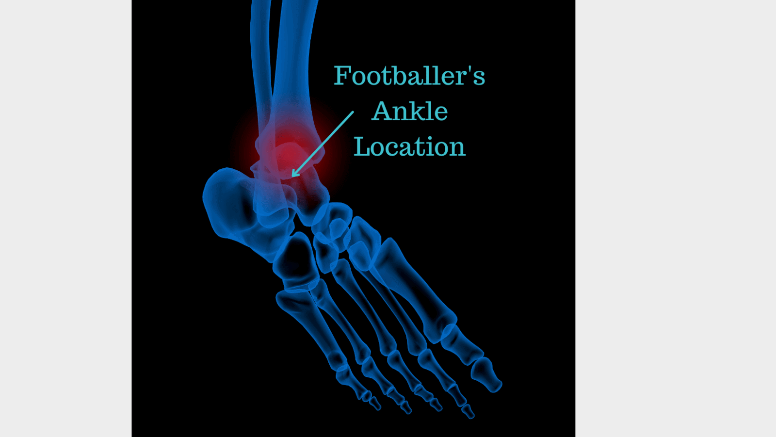 Footballer's Ankle Diagnosis, Causes, Symptoms and Treatment