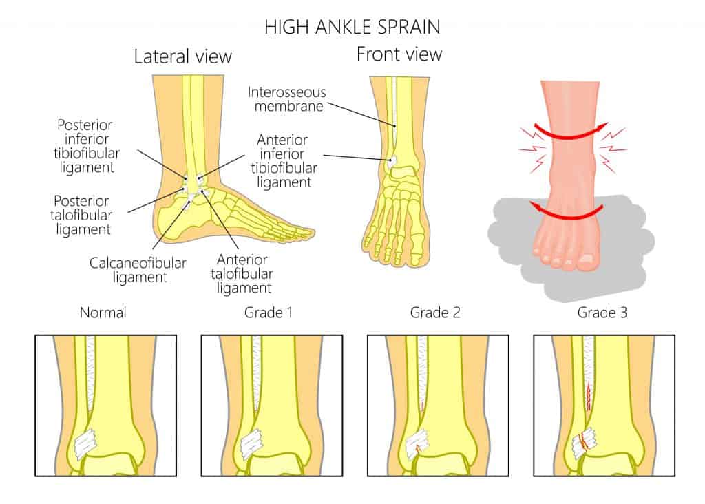 High Ankle Sprain Diagram