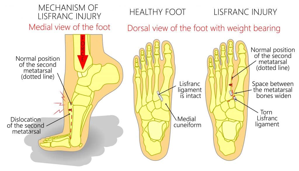 Lisfranc Injury Diagram