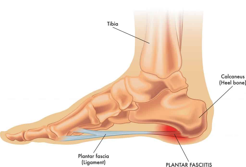 Plantar fasciitis diagram