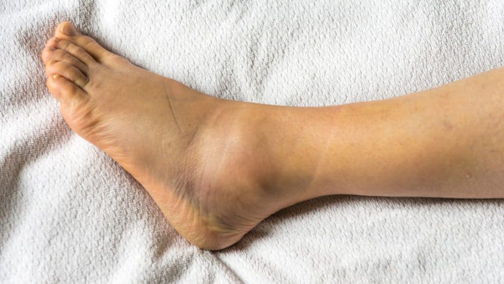 Picture of Sprained Ankle Bruising