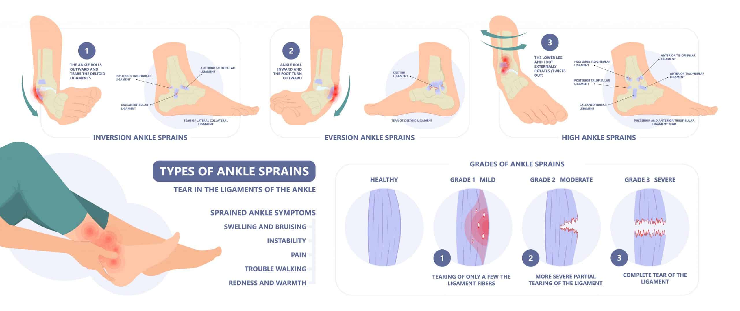 Types of Ankle Sprains, Symptoms and Treatments: Phoenician Foot