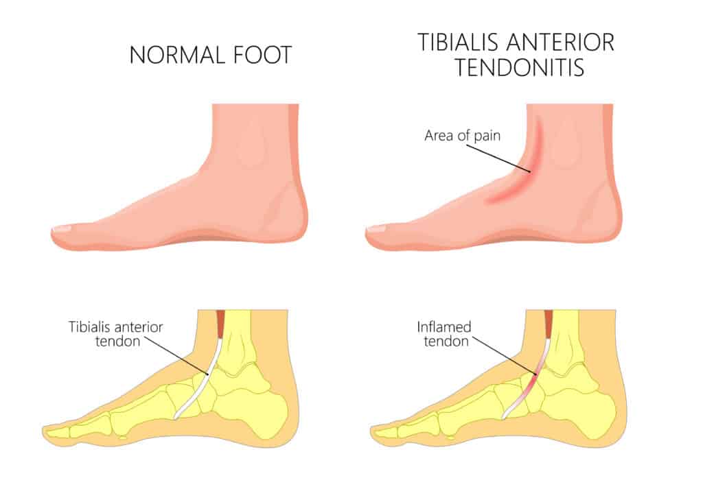 Tibialis Anterior Tendonitis Diagram