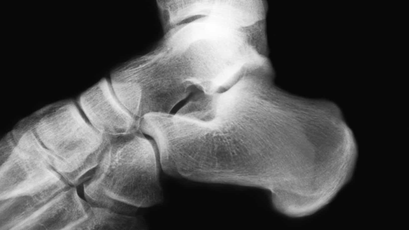 Os Trigonum | Back of Ankle Pain Explained by a Foot Specialist