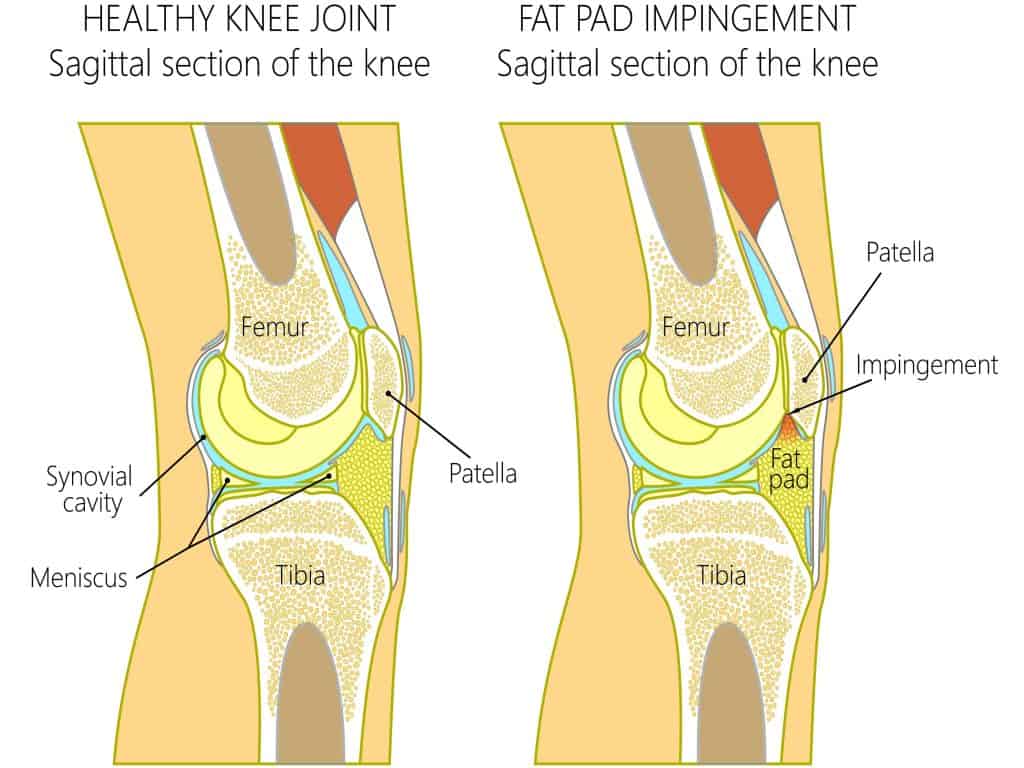 Picture diagram of knee fat pad impingement