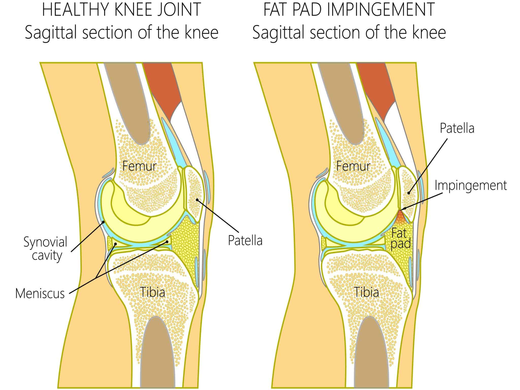 Hoffa's Fat Pad Symptoms, Diagnosis and Treatment
