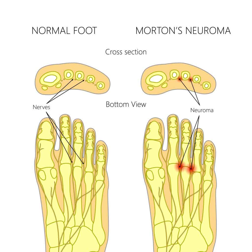 Picture of Morton's Neuroma Diagram