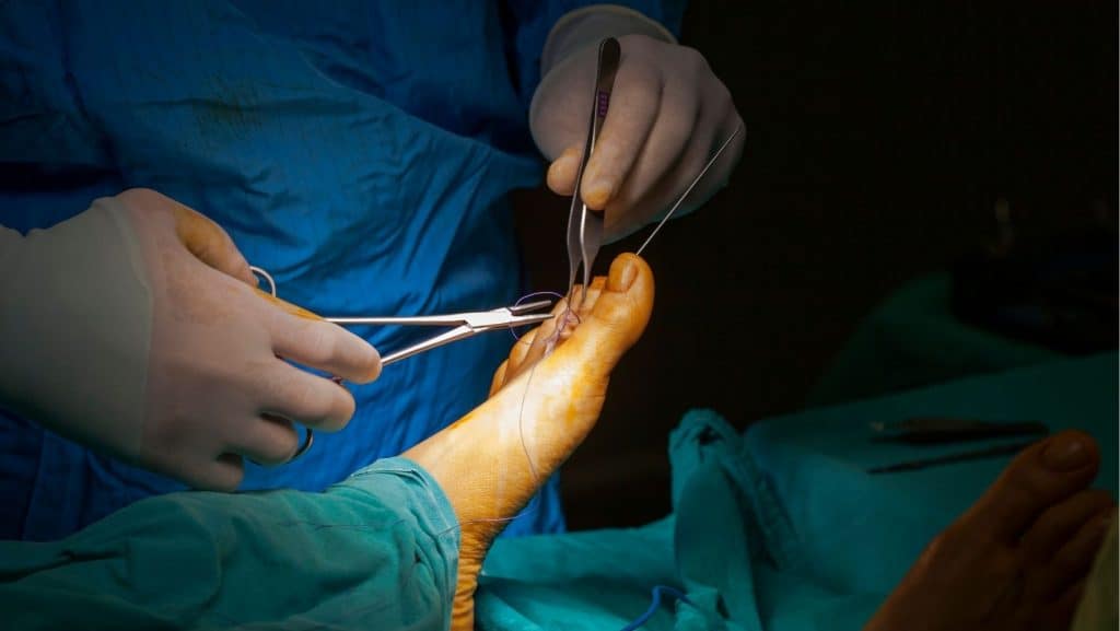 Picture of Morton's Neuroma Surgery