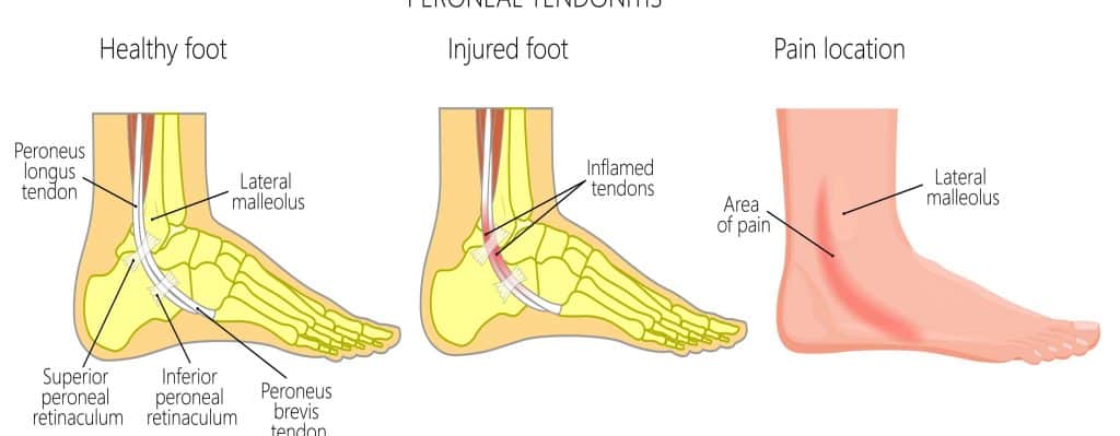 Diagram of what peroneal tendonitis feels like