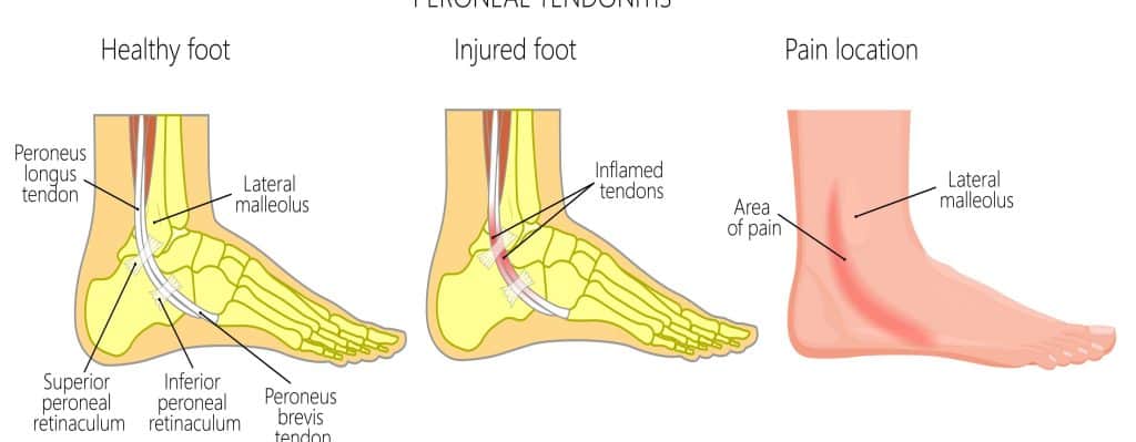 Peroneal Tendonitis: The most common questions answered